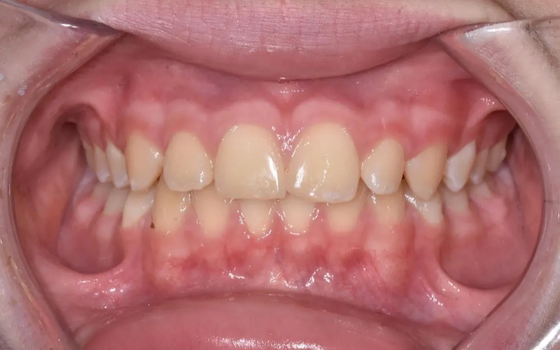 The same patient’s teeth and jaw after early intervention treatment