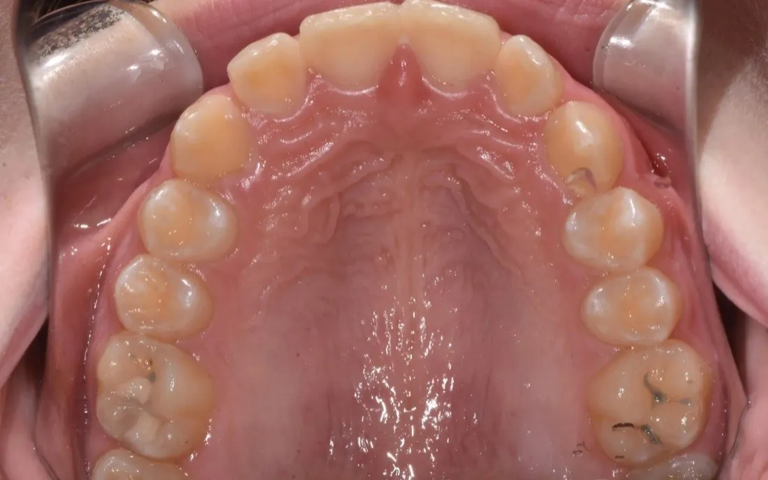 The same patient’s teeth and jaw after early intervention treatment