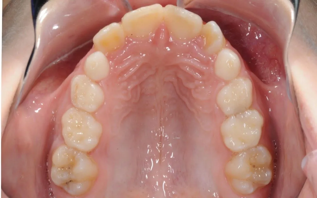 A patient’s teeth and jaw before early intervention treatment