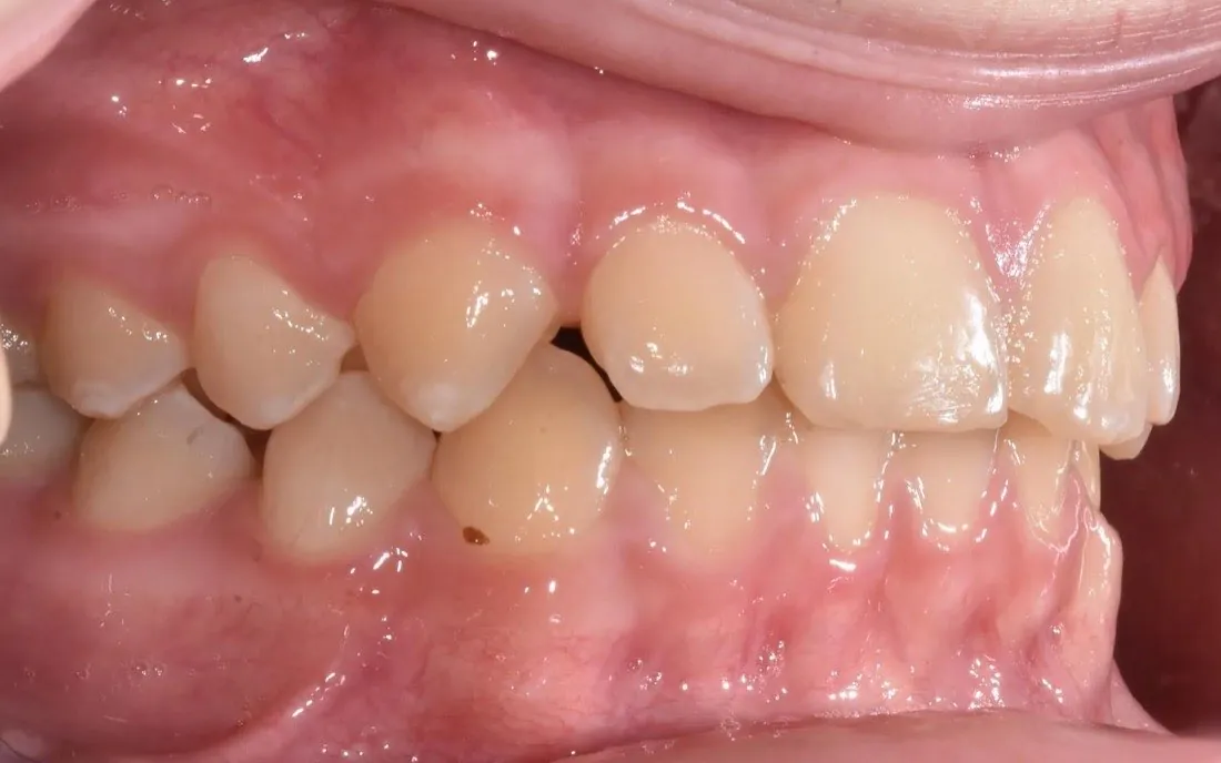 The same patient’s teeth and jaw after early intervention treatment