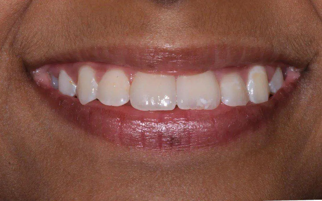 The same patient’s teeth and jaw after early intervention treatment