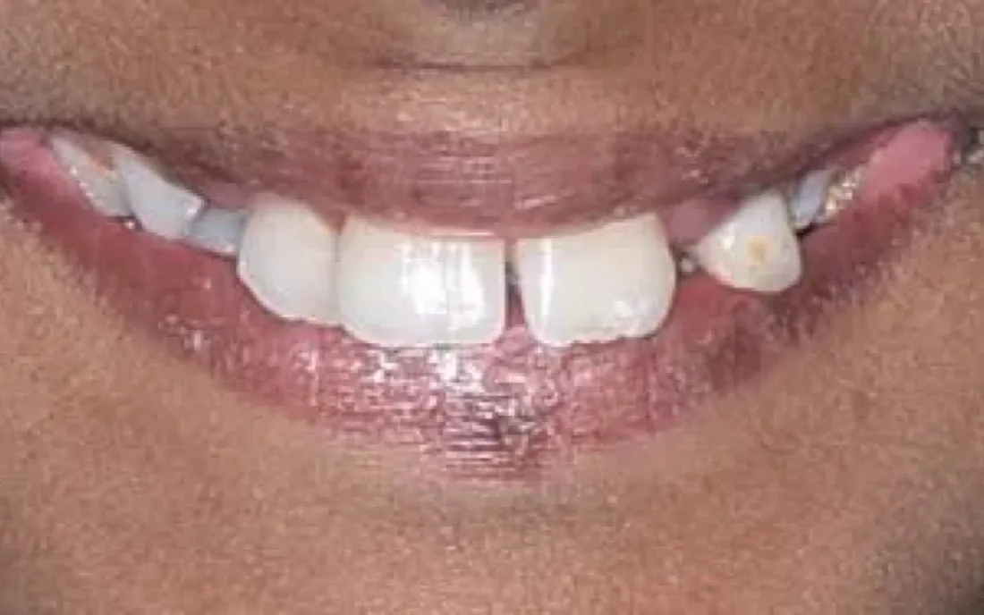 A patient’s teeth and jaw before early intervention treatment