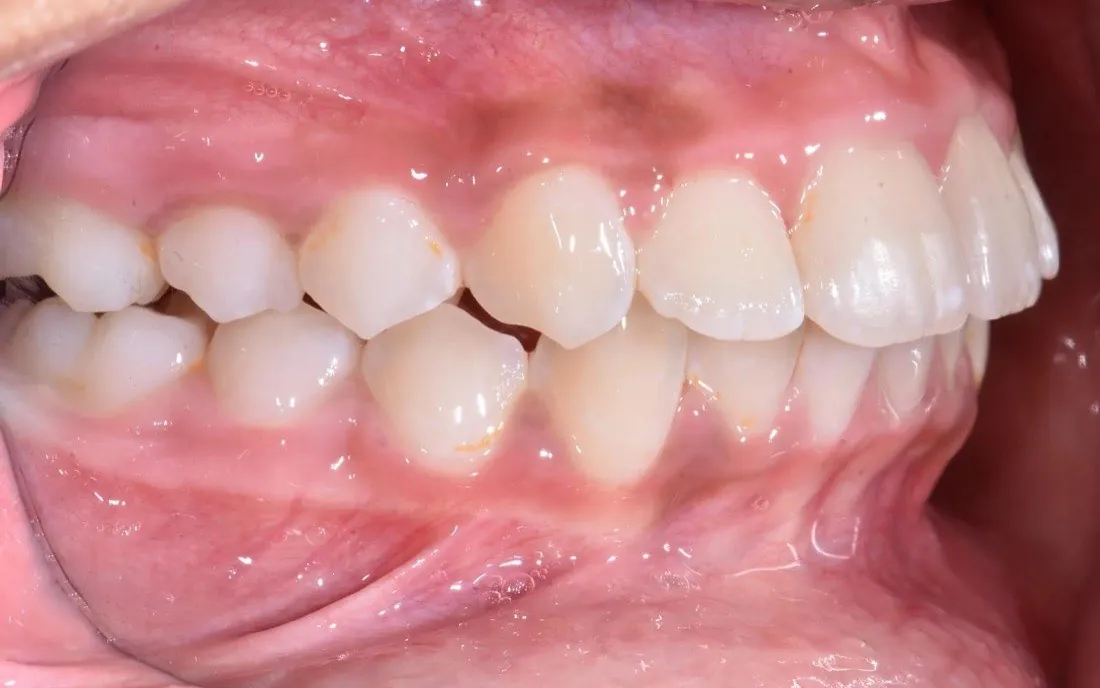 The same patient’s teeth and jaw after early intervention treatment