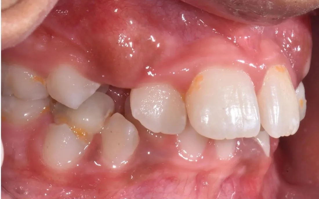 A patient’s teeth and jaw before early intervention treatment