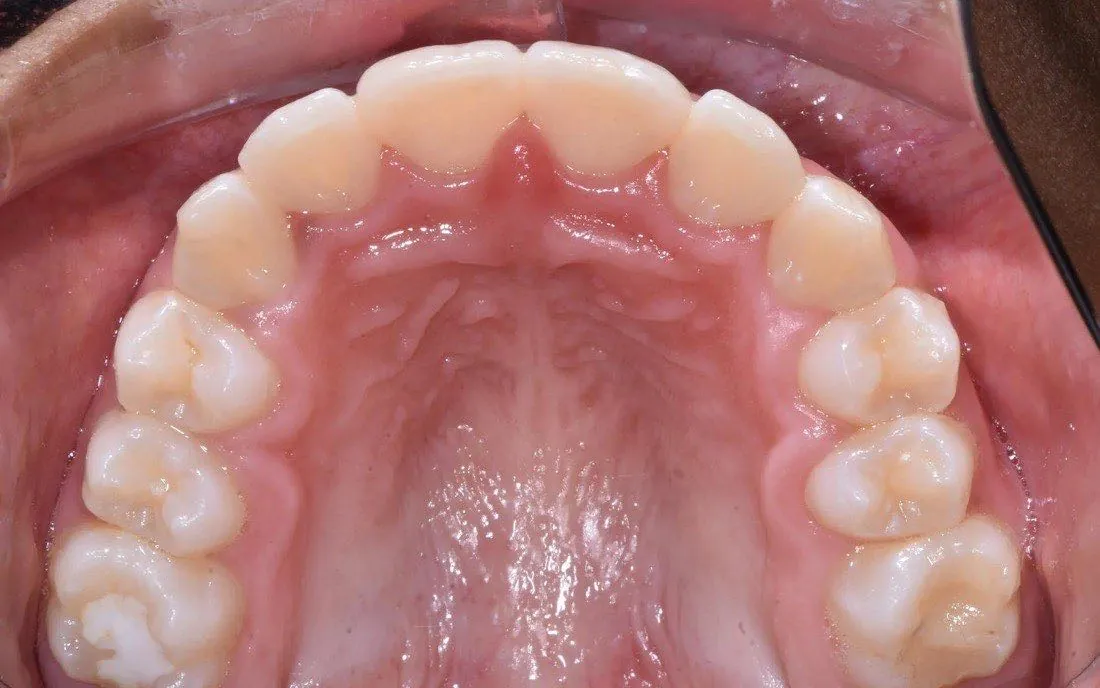 The same patient’s teeth and jaw after early intervention treatment