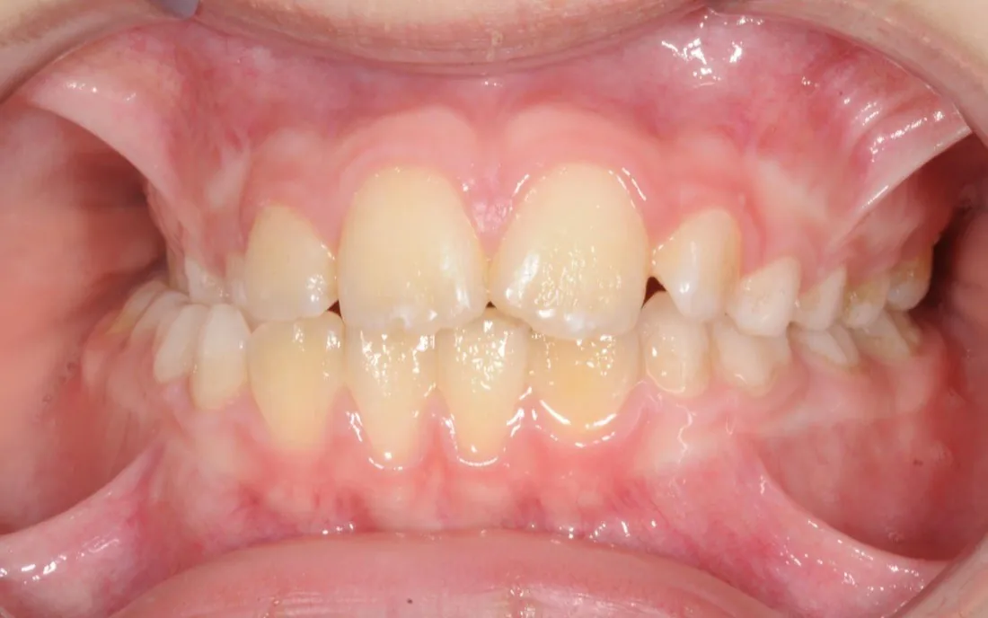 A close front view of a child’s teeth before early treatment, the upper front teeth crowded and overlapping
