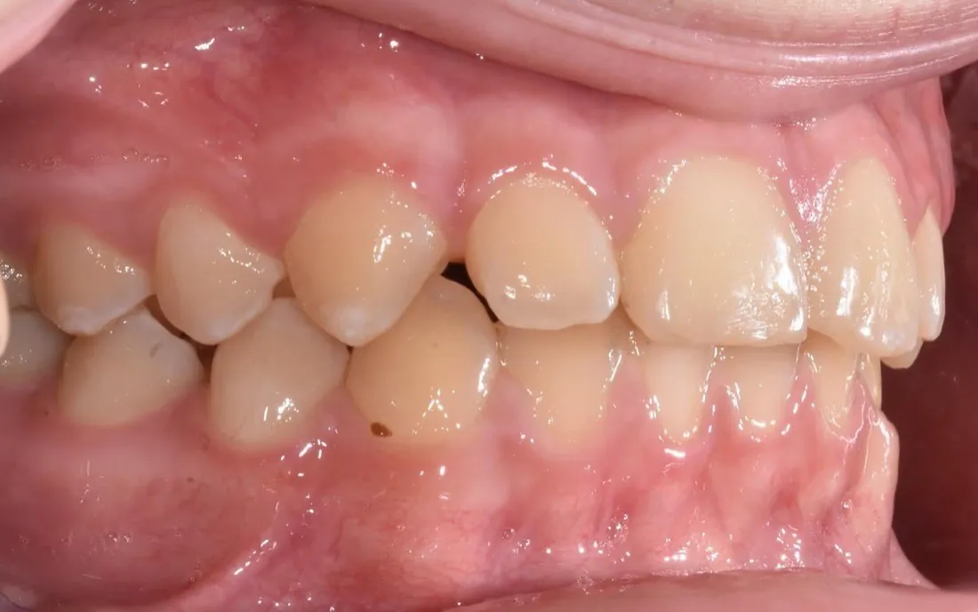 The same side view after early treatment, the upper and lower teeth meeting evenly