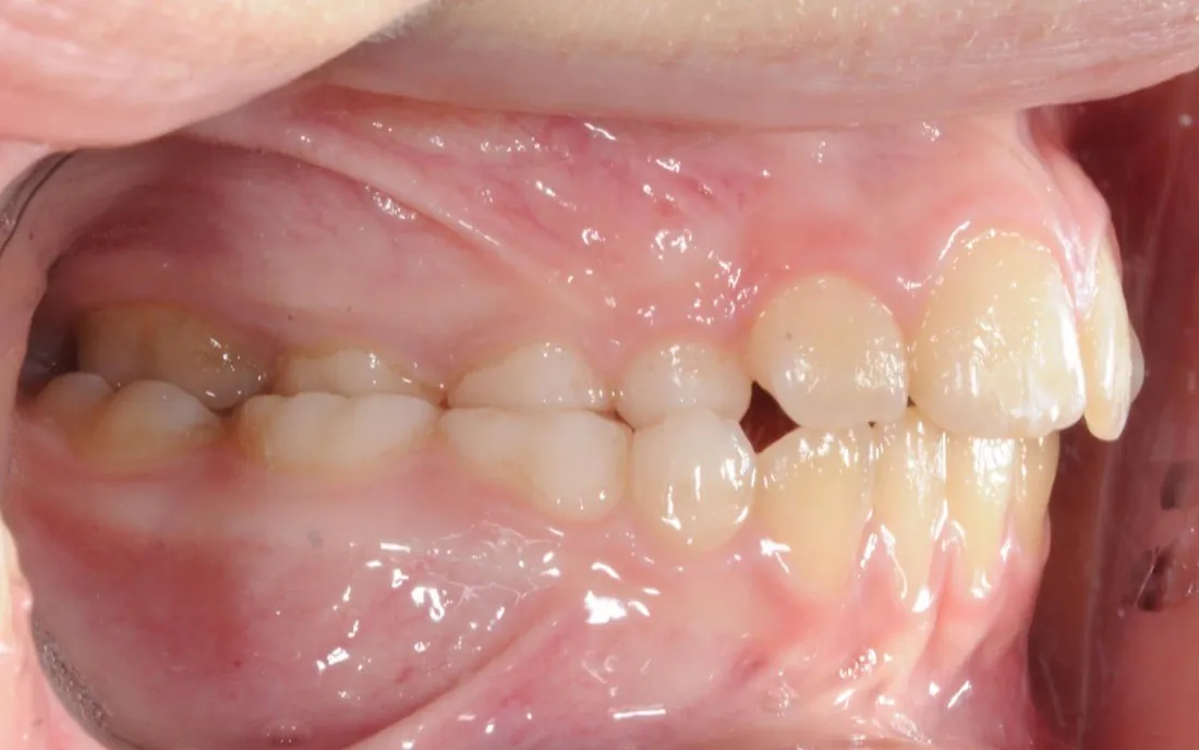 A side view of the same child’s teeth before early treatment, the upper front teeth standing well ahead of the lower