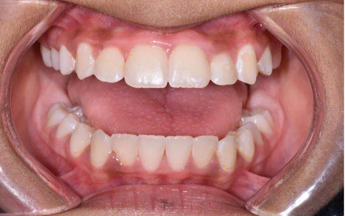 The same front view after early treatment, with the front teeth meeting
