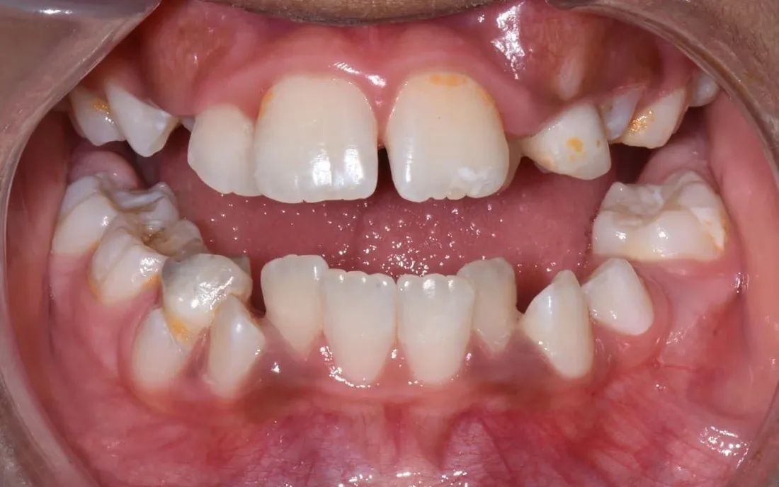 A close front view of a child’s teeth before early treatment, with a gap between the upper and lower front teeth when the back teeth are together