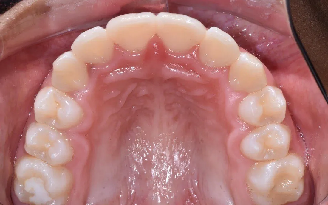 The same view after early treatment, the upper arch broader and the teeth in line