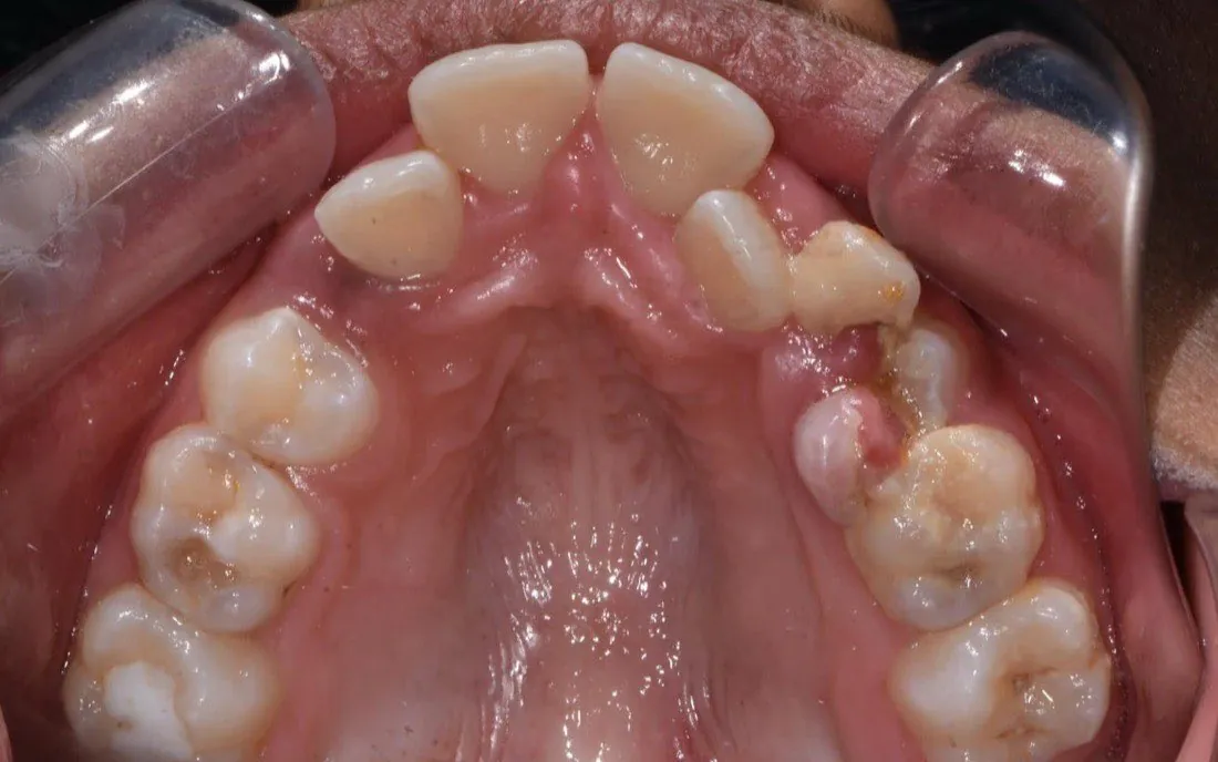 A view up into the same child’s upper arch before early treatment, the arch narrow and the front teeth turned