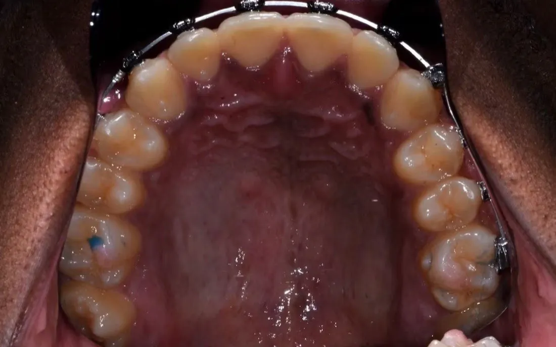 The same patient’s upper jaw after palatal expansion