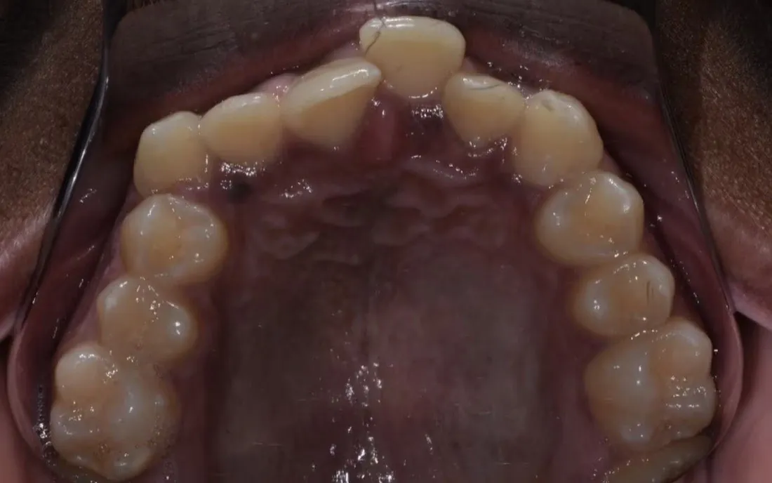 A patient’s upper jaw before palatal expansion