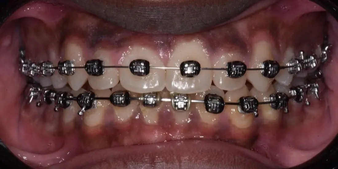 The same patient’s upper jaw after palatal expansion