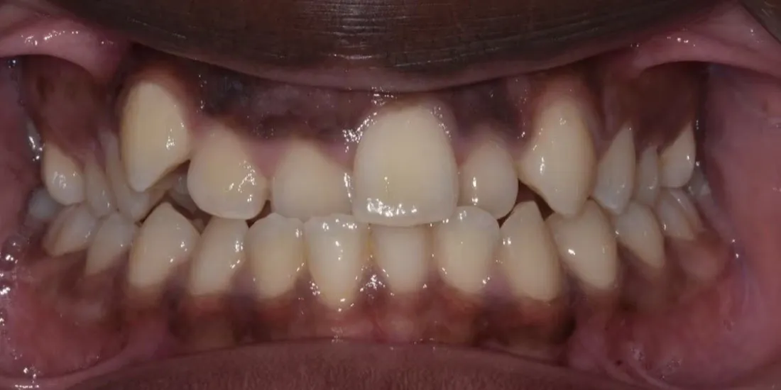 A patient’s upper jaw before palatal expansion