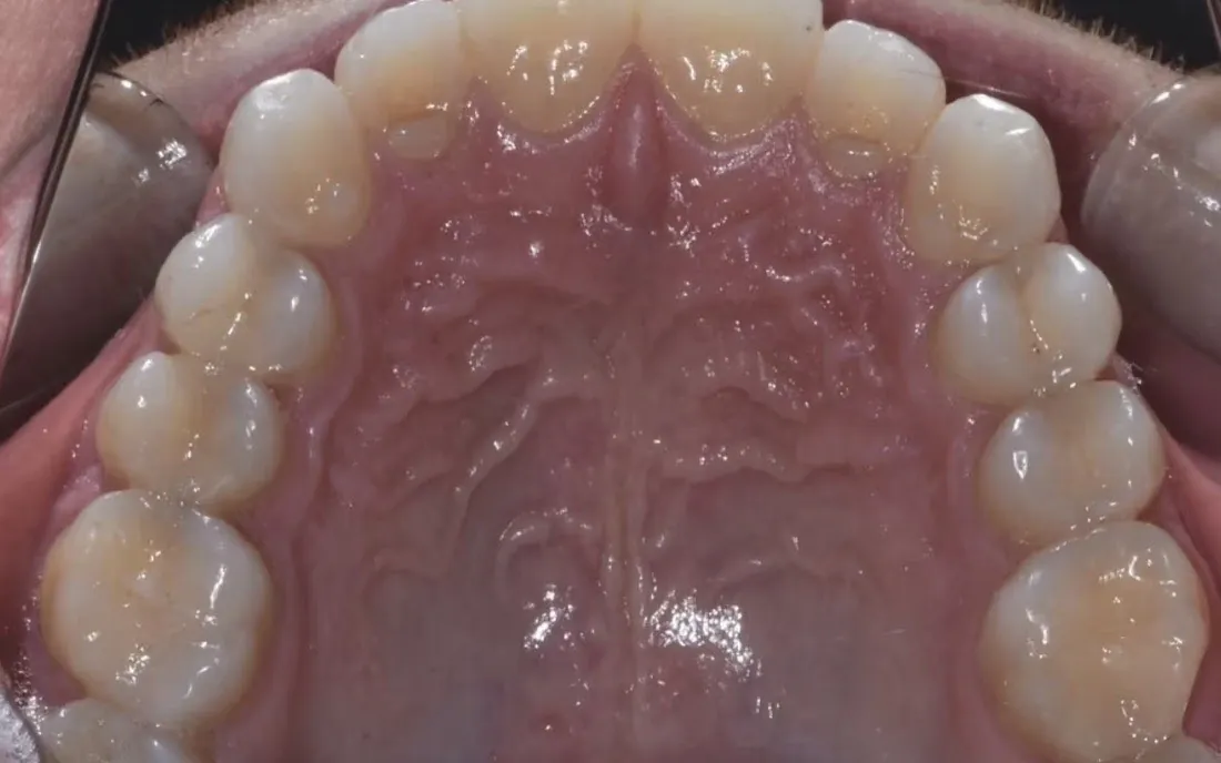 The same patient’s upper jaw after palatal expansion