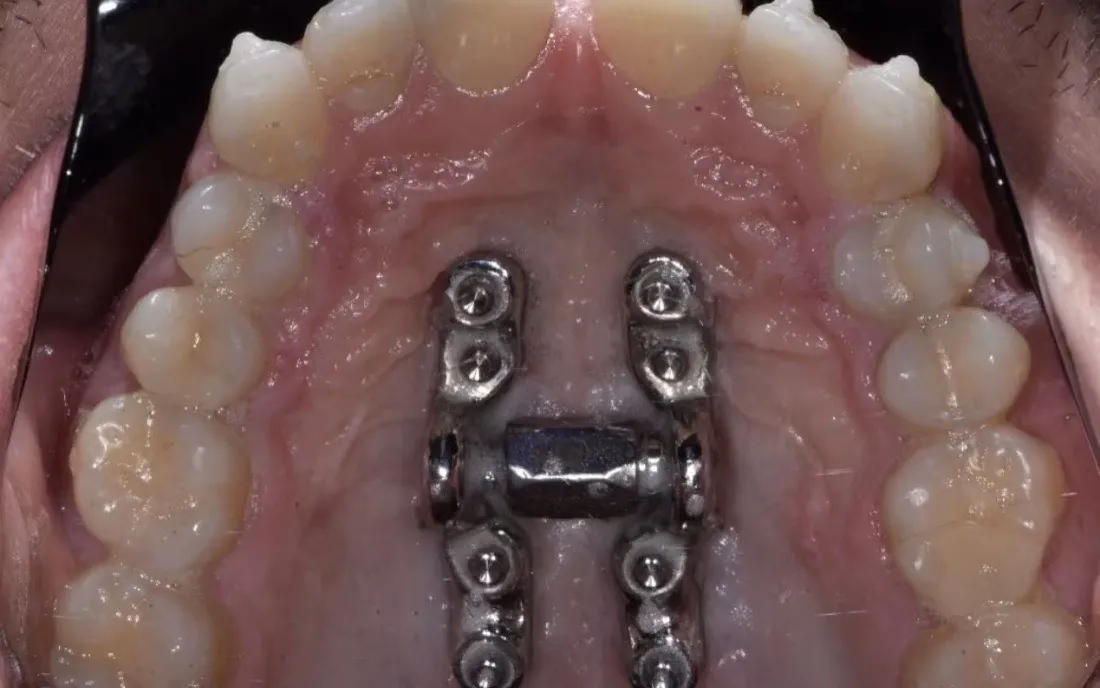 A patient’s upper jaw before palatal expansion