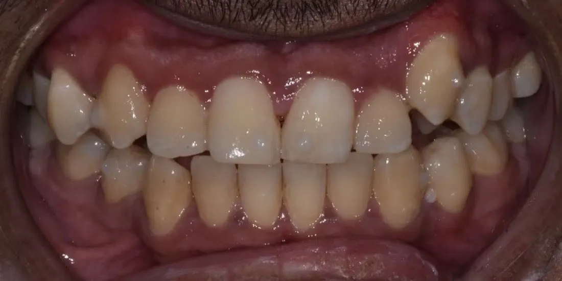The same patient’s upper jaw after palatal expansion
