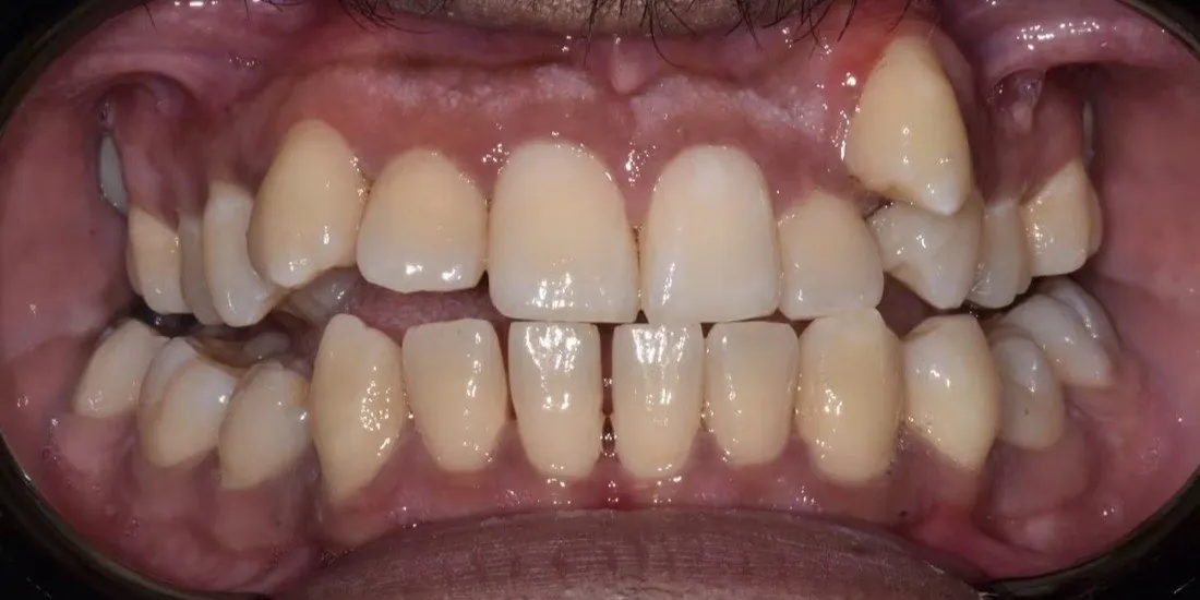 A patient’s upper jaw before palatal expansion
