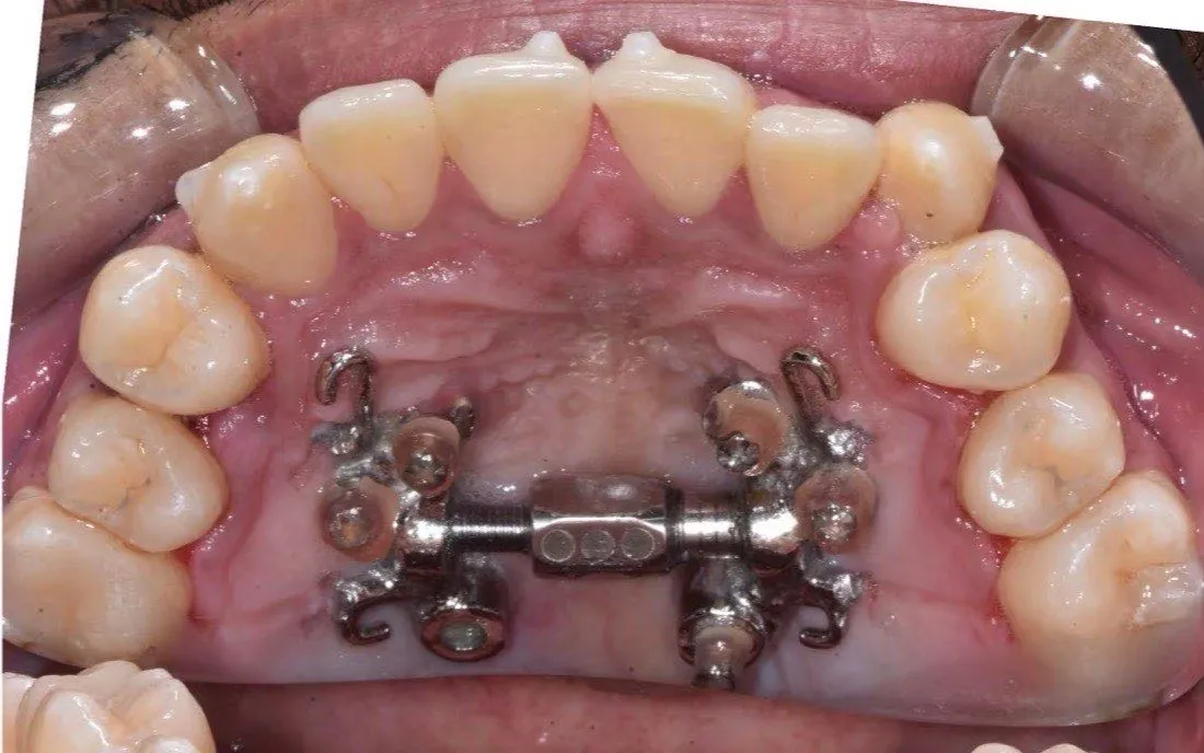 The same patient’s upper jaw after palatal expansion