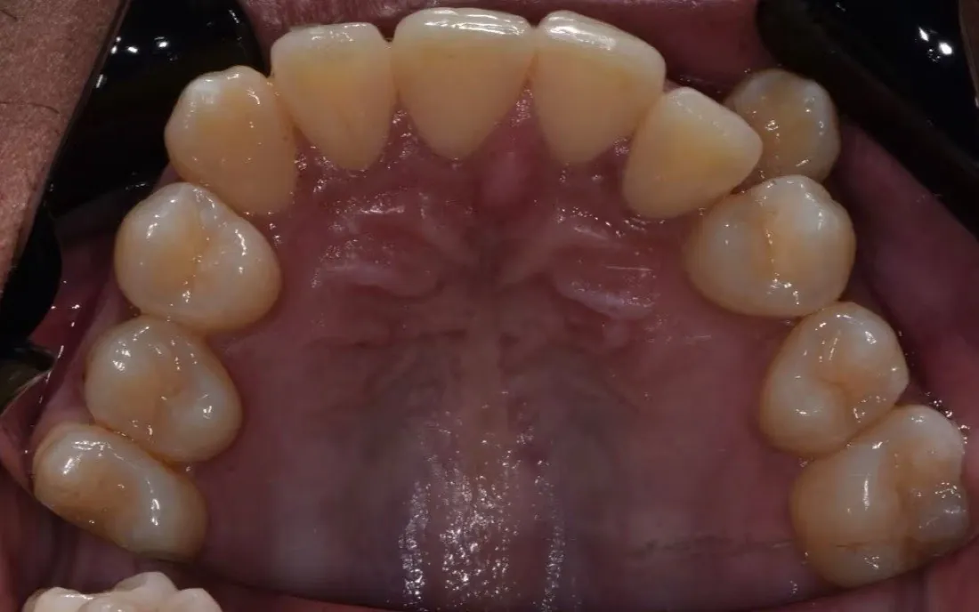 A patient’s upper jaw before palatal expansion