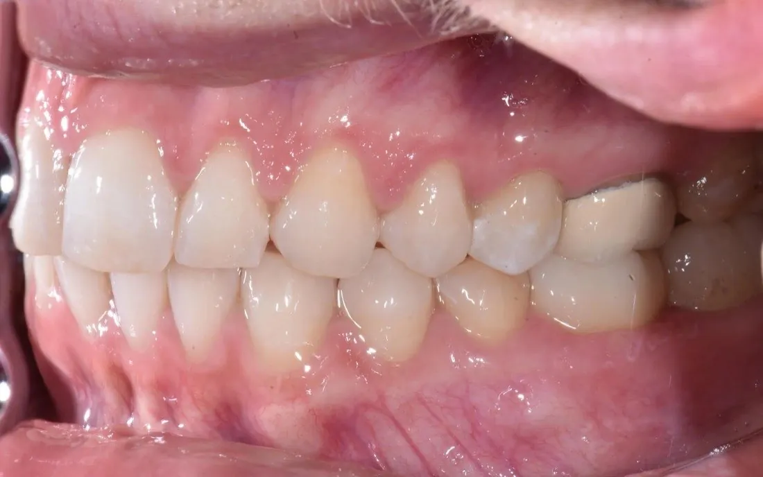 The same patient’s teeth after hybrid braces-and-aligner treatment