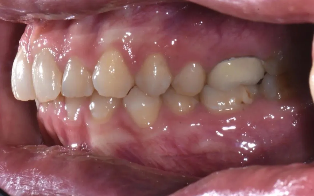 A patient’s teeth before hybrid braces-and-aligner treatment