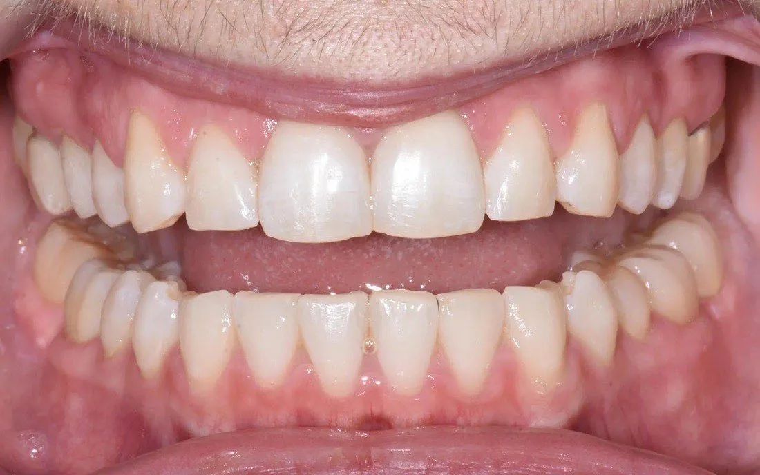 The same patient’s teeth after hybrid braces-and-aligner treatment