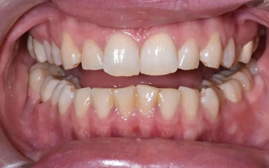 A patient’s teeth before hybrid braces-and-aligner treatment