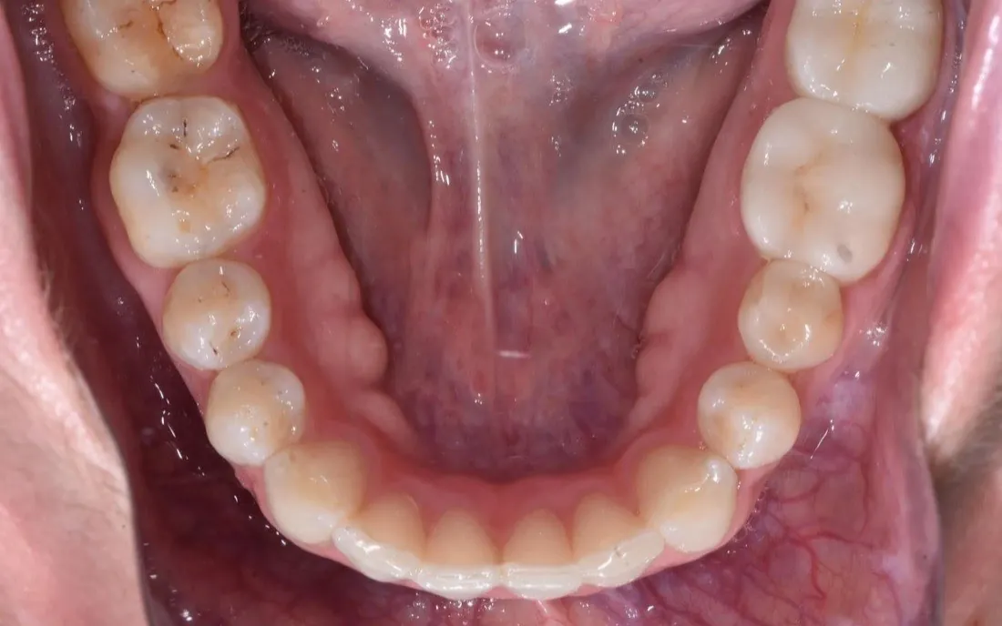 The same patient’s teeth after hybrid braces-and-aligner treatment