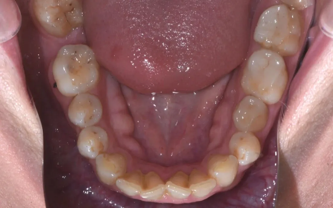 A view down onto the lower teeth before treatment, the front teeth overlapping