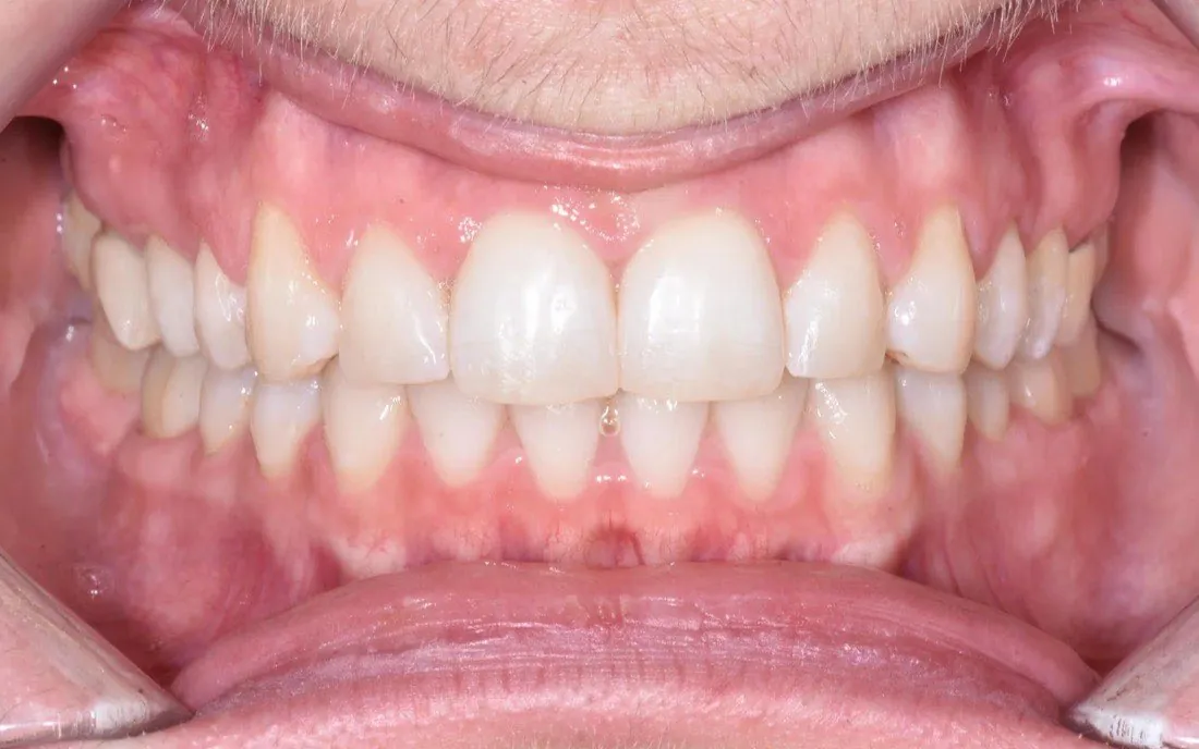 The same front view after treatment, the upper and lower teeth meeting evenly