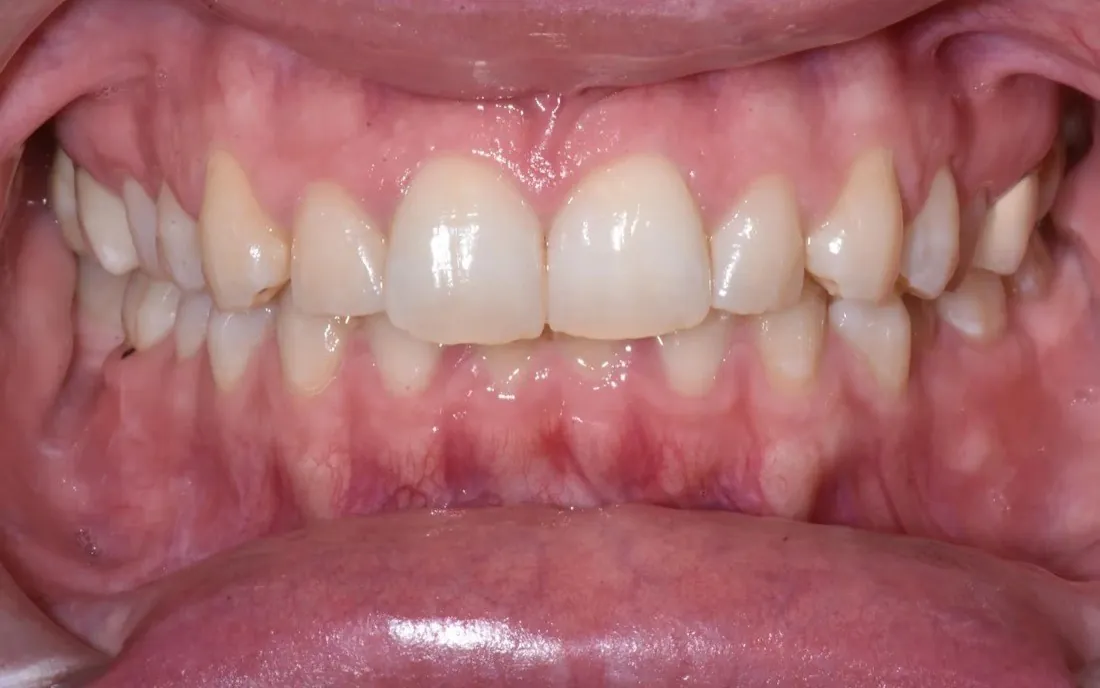 A front view of the teeth before treatment, the upper front teeth crowded and turned