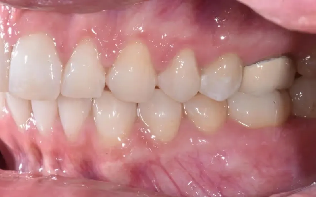 The same side view after treatment, the teeth meeting evenly along the arch