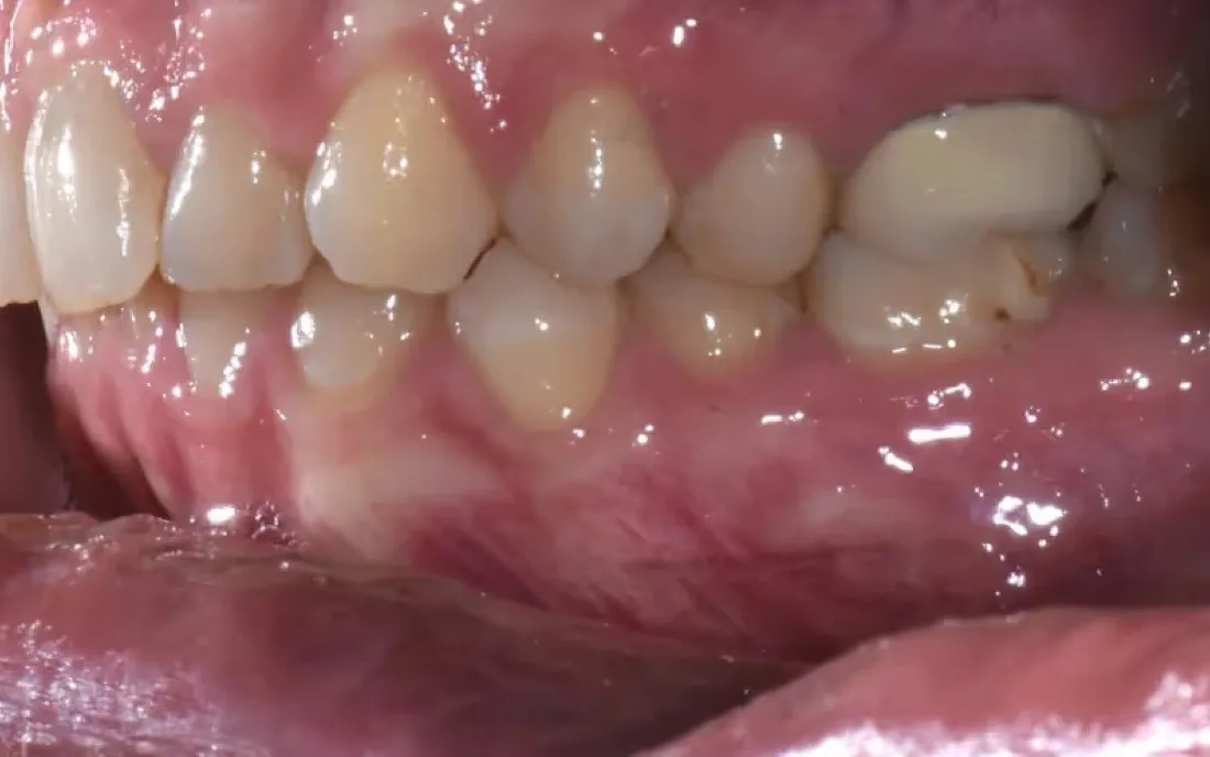 A side view of the teeth before treatment, the upper and lower teeth not lining up
