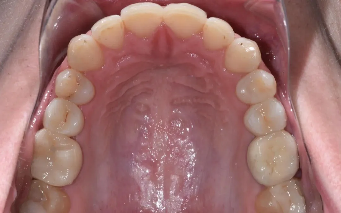 The same view after treatment, the upper arch even and rounded