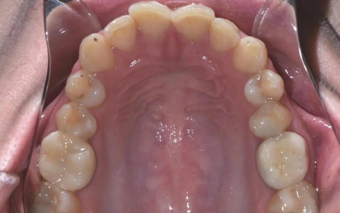 A view up into the upper arch before treatment, the front teeth out of line