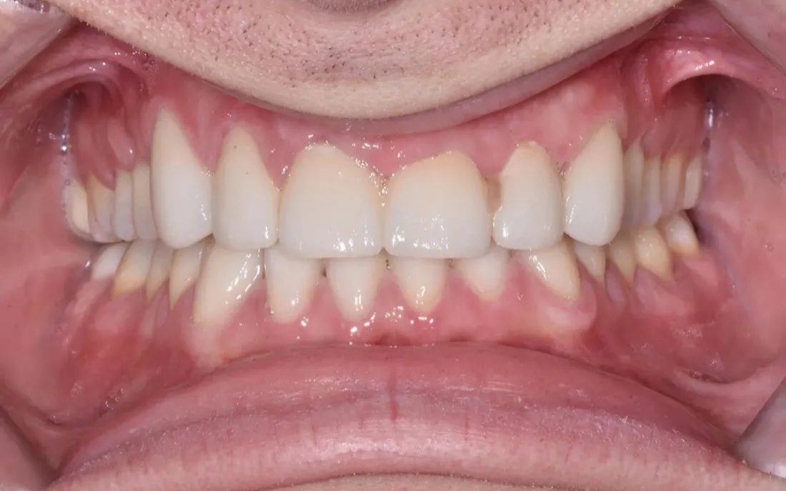 The same front view after treatment, the upper front teeth longer and even