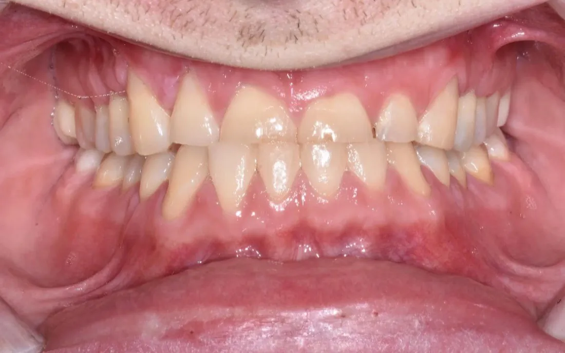 A front view of the same patient’s teeth before treatment, the upper front teeth short with uneven edges