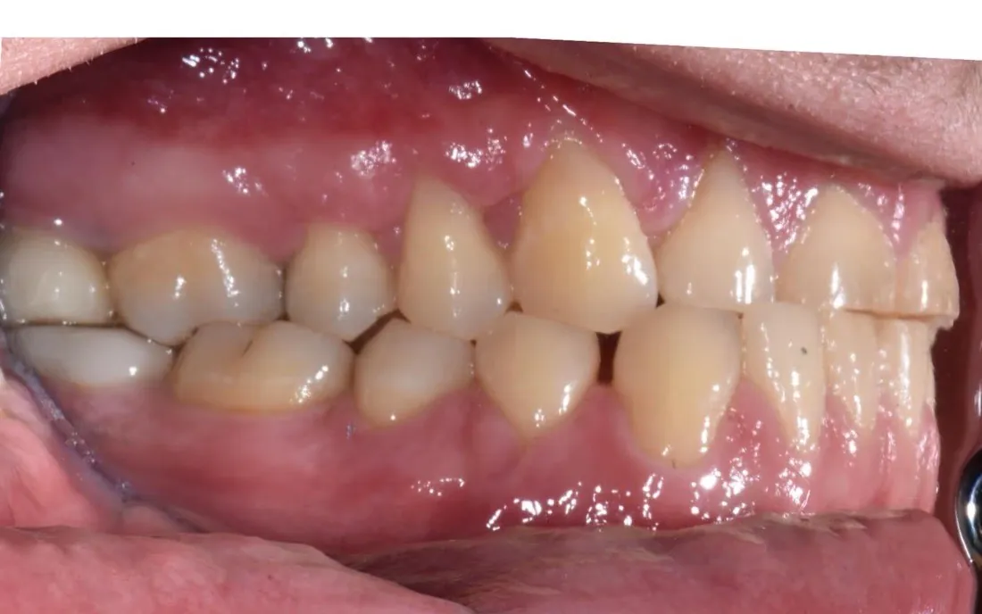 A side view of a patient’s teeth before treatment, the upper teeth short and unevenly worn along the edges