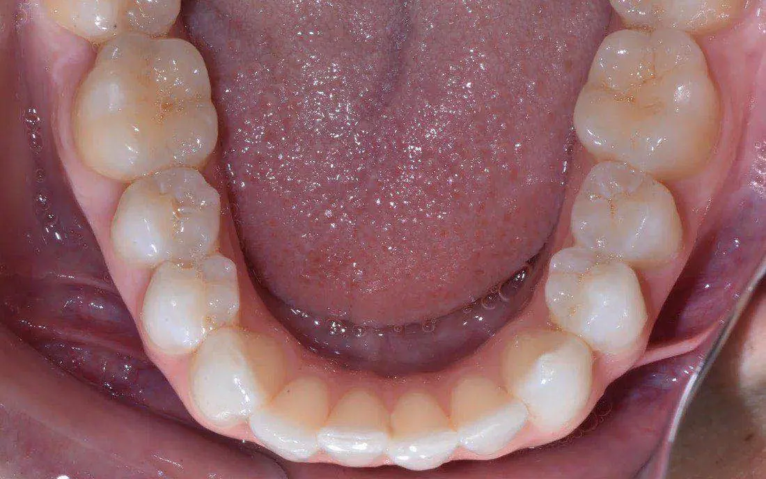 A view down onto a patient’s lower teeth before treatment, the front teeth crowded and overlapping