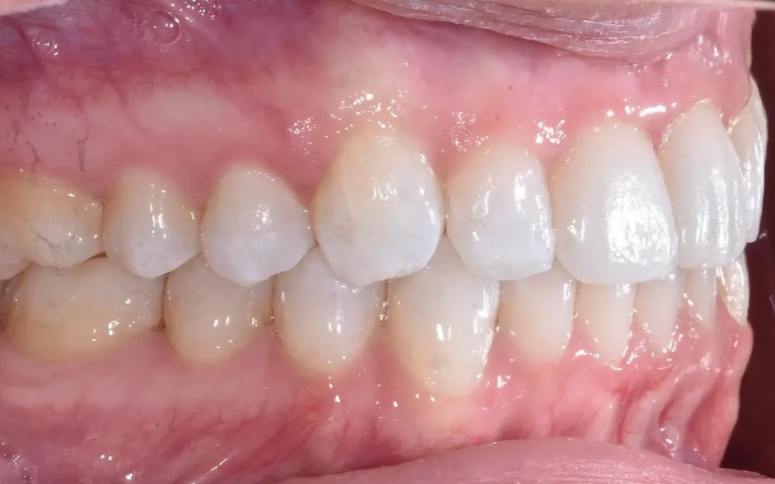 The same side view after treatment, the teeth meeting along the arch