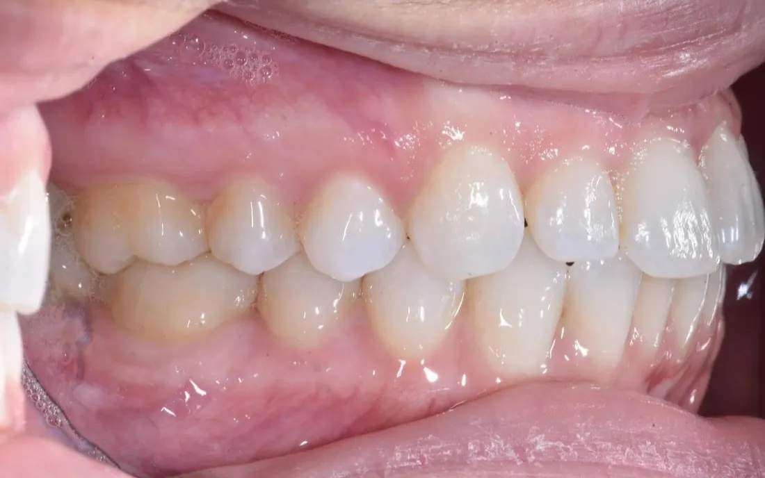 A side view of the same patient’s teeth before treatment, the upper and lower teeth not meeting evenly