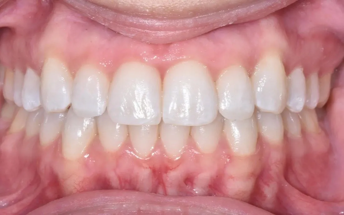 The same patient’s teeth and bite after interdisciplinary orthodontic treatment