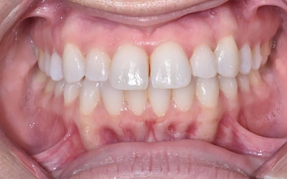 A patient’s teeth and bite before interdisciplinary orthodontic treatment
