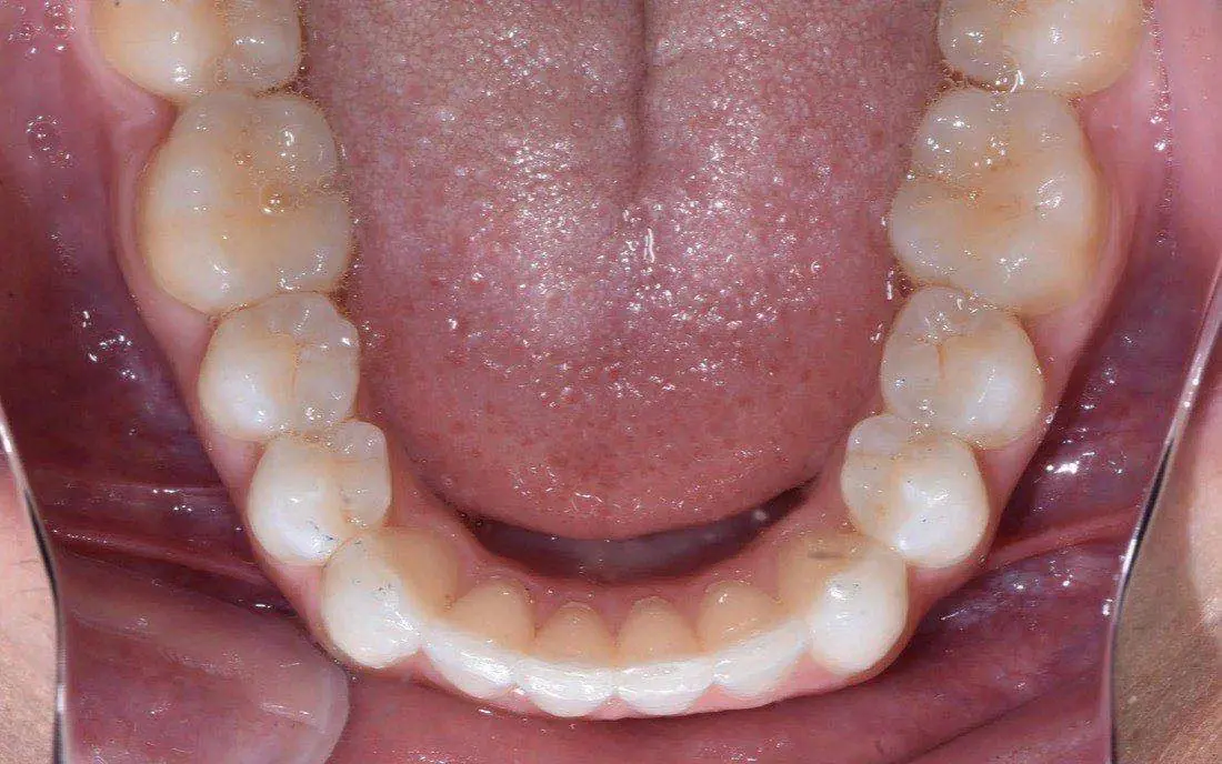 The same patient’s teeth and bite after interdisciplinary orthodontic treatment