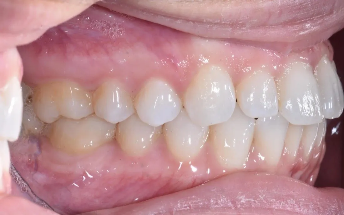 A patient’s teeth and bite before interdisciplinary orthodontic treatment