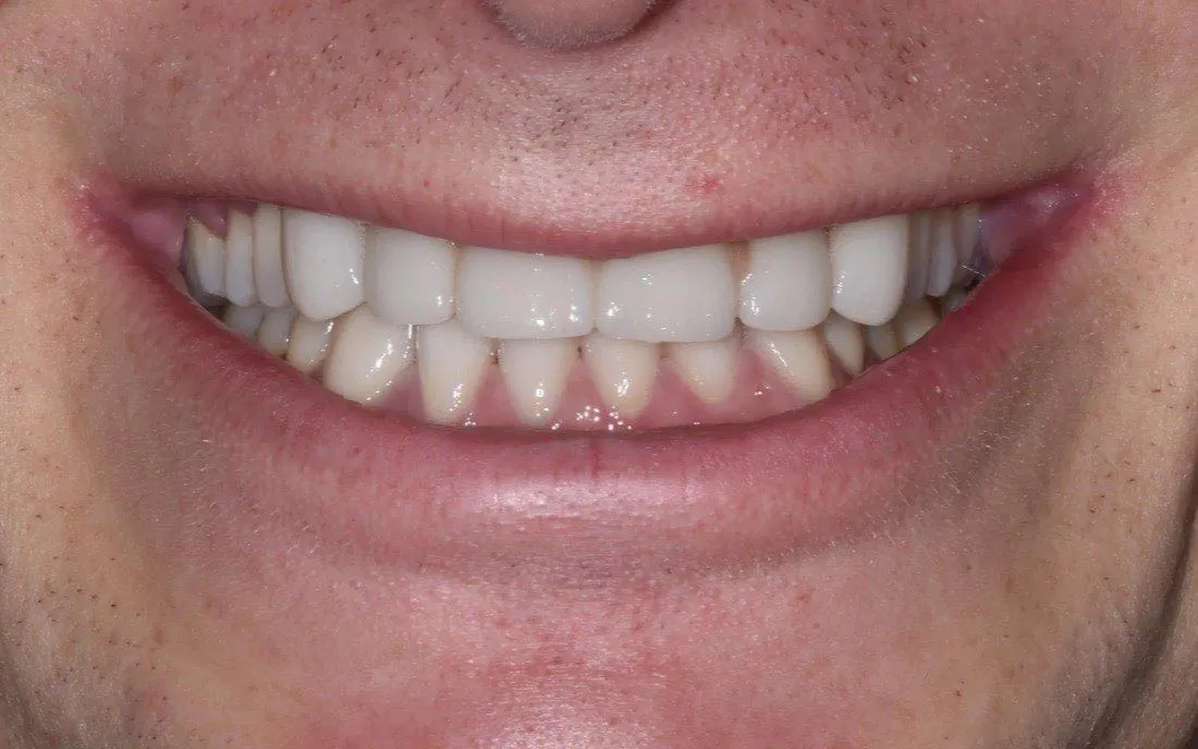 The same patient’s teeth and bite after interdisciplinary orthodontic treatment