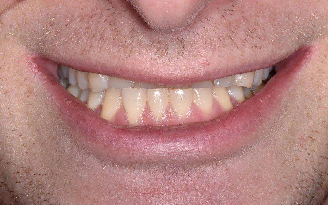 A patient’s teeth and bite before interdisciplinary orthodontic treatment